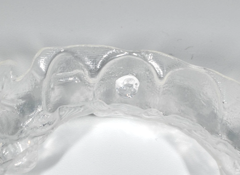 Image shows a small dot of teeth whitening gel in a teeth whitening tray, applied in the center of the facial surface of a front tooth.